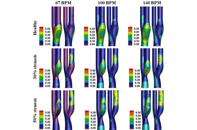 Exercise may induce strokes for people with blocked arteries