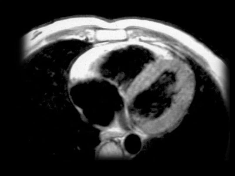 Sudden Cardiac Death in Athletes