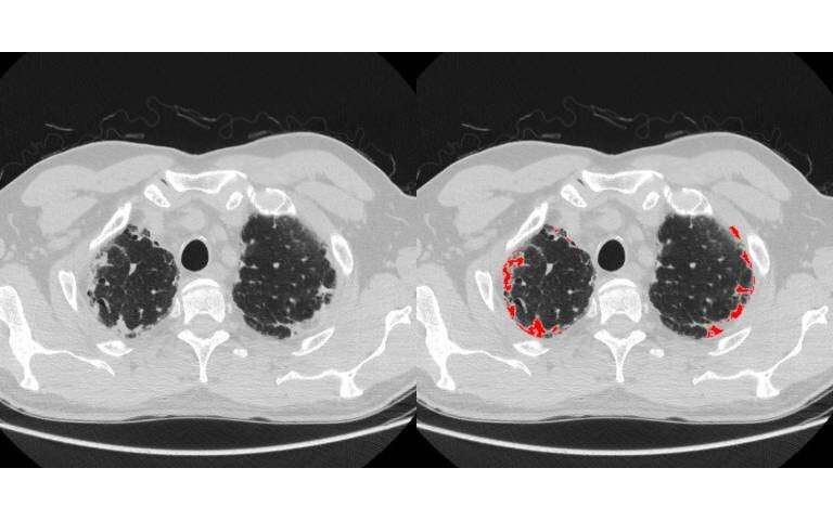 Computerised image analysis identifies new subtype of debilitating lung disease