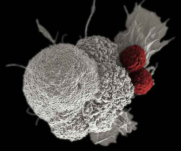Two cytotoxic T cells attack an oral squamous cancer cell.