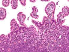 Micrografía de células de linfoma de células del manto en el intestino delgado.