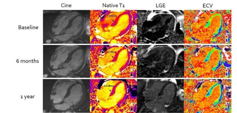 Advanced MRI benefits patients with heart stiffening disease