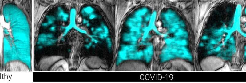 Innovative lung-imaging technique shows cause of long-COVID symptoms