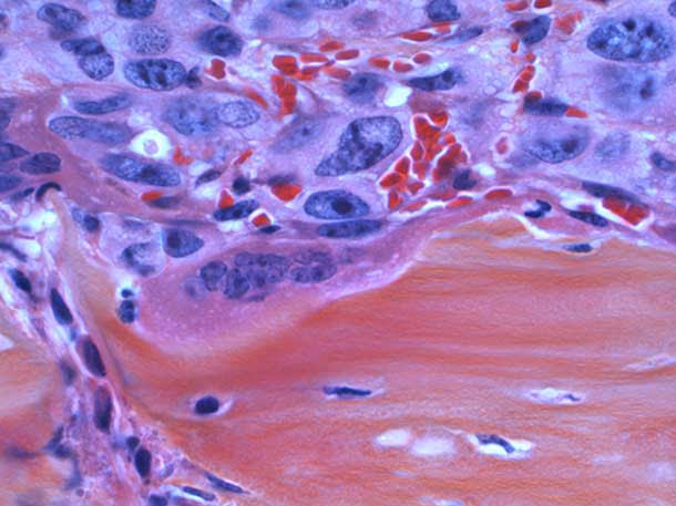Micrograph of prostate cancer spreading to bone.