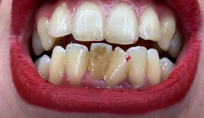 Dental Trick Reverses Years Of Damage In Minutes
