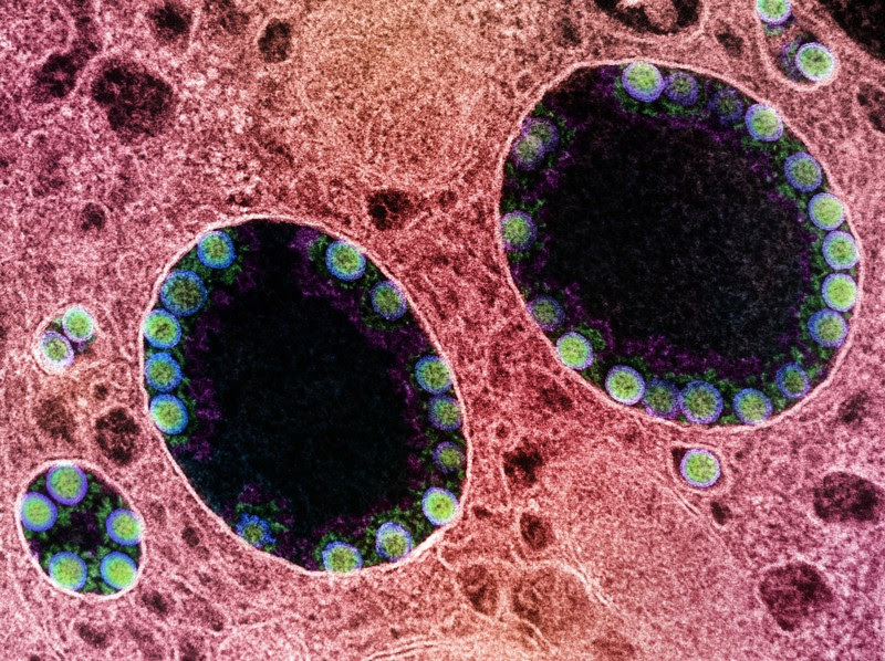 Transmission electron micrograph of SARS-CoV-2 virus particles within endosomes of a heavily infected nasal cell