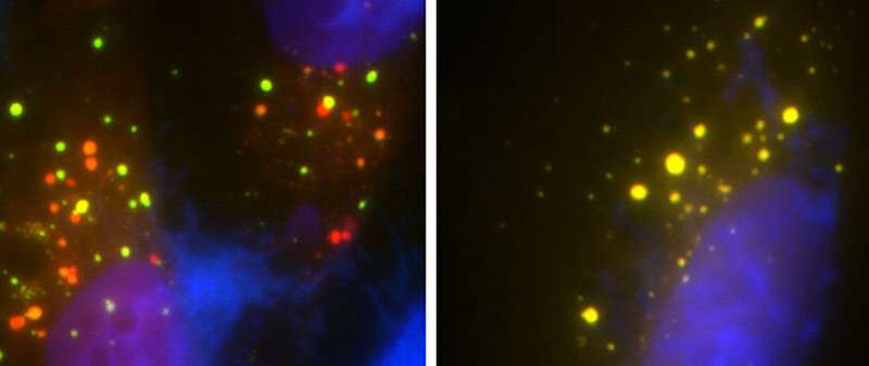 Researchers identify new genetic defect linked to ALS