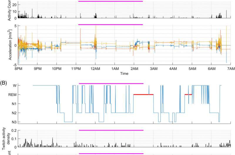 Researchers develop one of the first sleep screening methods using wearables to predict, detect Parkinson's onset