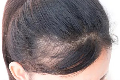 tratamento-para-alopecia-frontal-em-bh