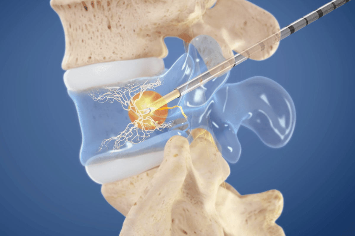 The Intracept procedure tackles lower back pain with heat via radio-frequency ablation