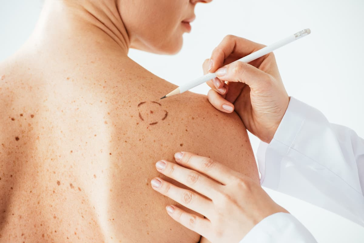 Following a phase 1 safety trial, researchers have found that combining immunotherapy for melanoma with fecal transplantation is safe and may improve treatment success