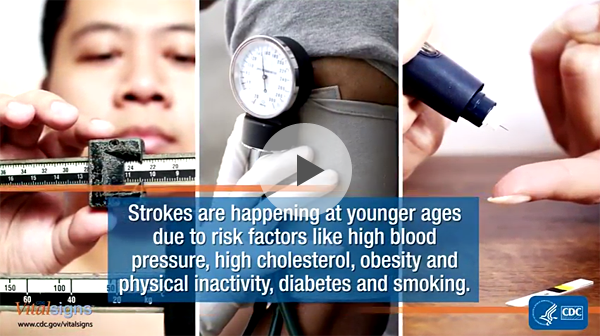 Preventing Stroke Deaths Prescribing Opioids