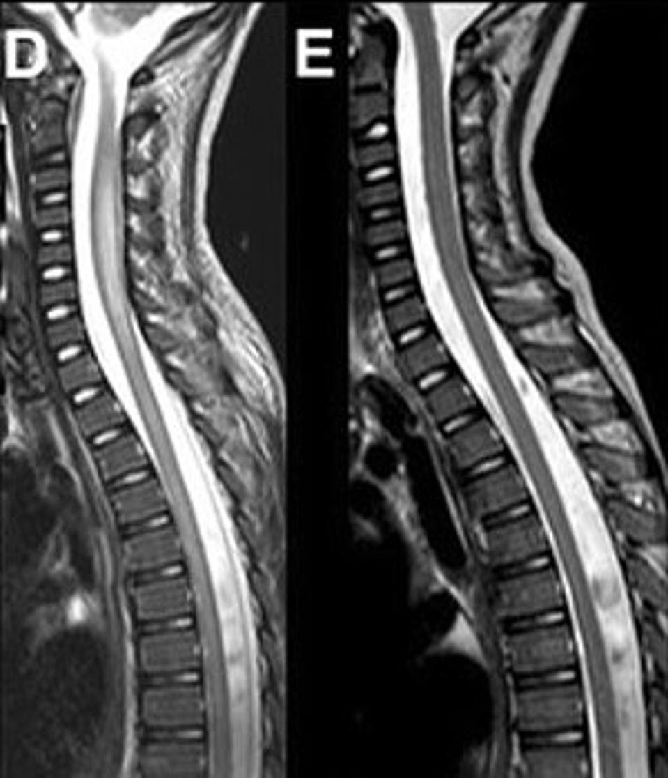 AFM spinal cord swelling