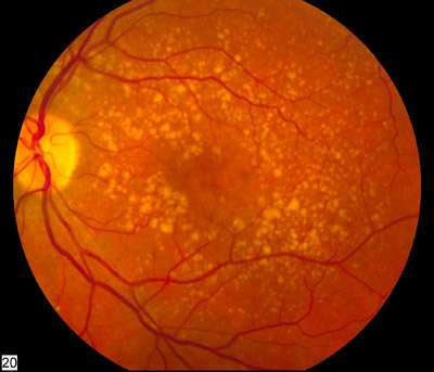 macular degeneration