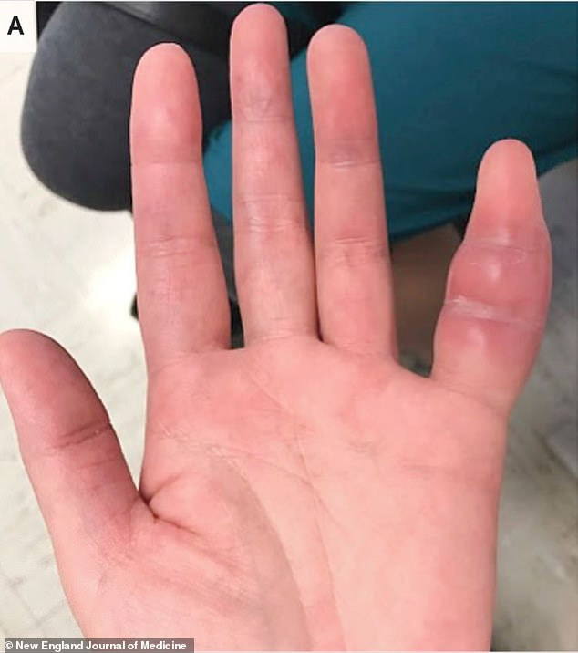 The unnamed woman, from California, went to hospital after the pinky finger on her left hand ballooned up and became red and painful for a week