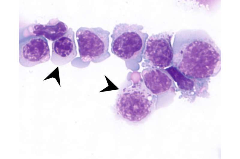 New drug combination shows promise in treating acute myeloid leukaemia